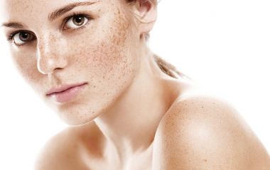 Веснушки и пигментные пятна