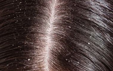 Как избавится от перхоти